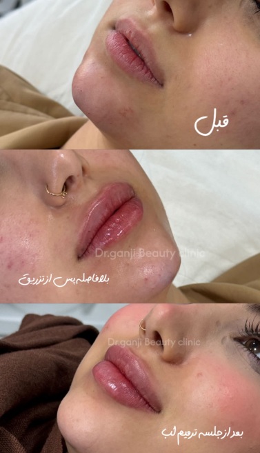 فیلر لب نچرال