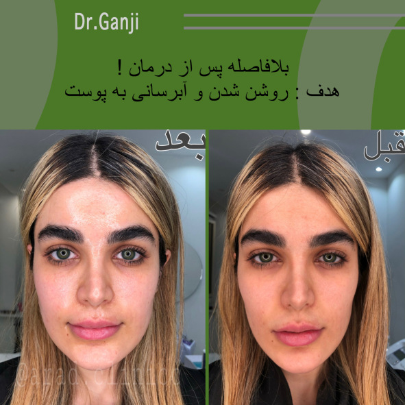 فیس آپ