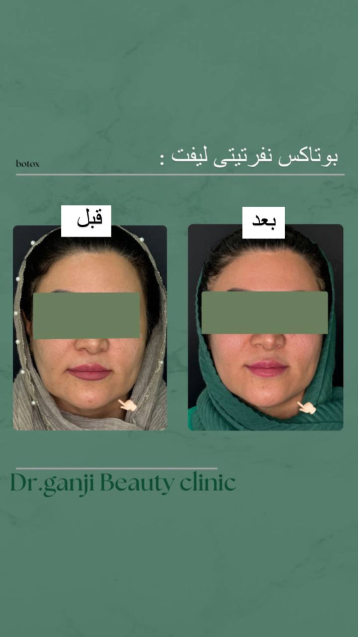 بوتاکس نفرتیتی