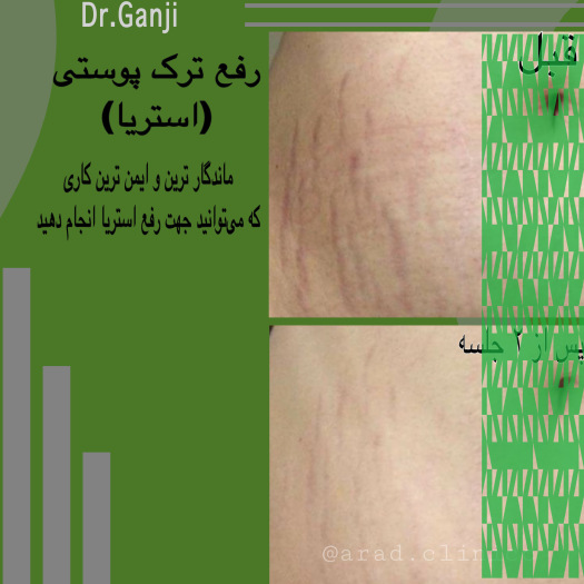 استریا