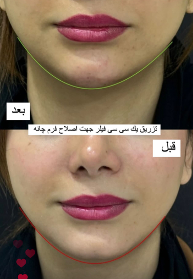 چانه
