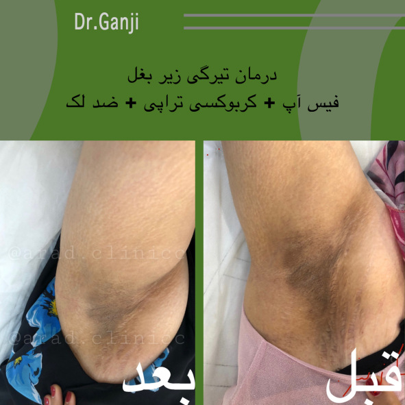 فیس آپ