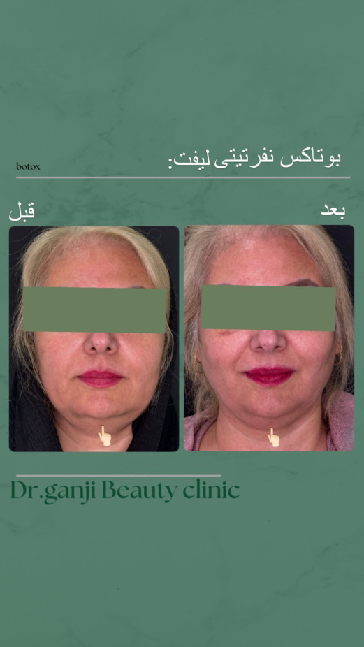 بوتاکس نفرتیتی