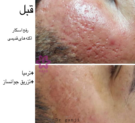 ترمیا