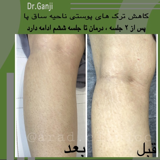 ترک پوستی 