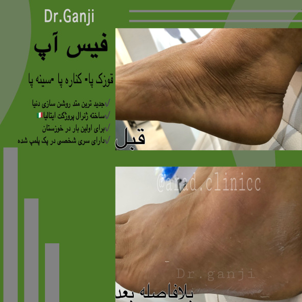 فیس آپ 