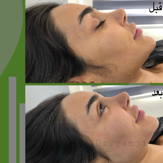 فیس آپ 